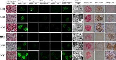 Clinicopathological and prognostic characteristics of idiopathic membranous nephropathy with dual antigen positivity